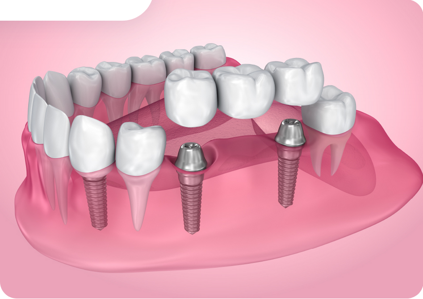 歯科用のCTを完備