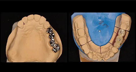 インプラント治療