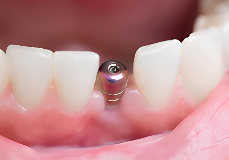 3次元CT解析で安全・精密なインプラント治療を国際認定医が提供