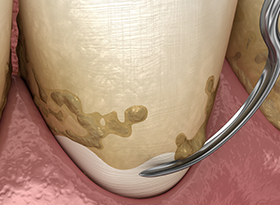 歯周ポケットが深い場合には外科的処置も行います