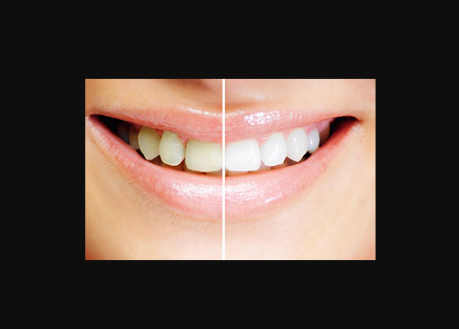 ホワイトニング