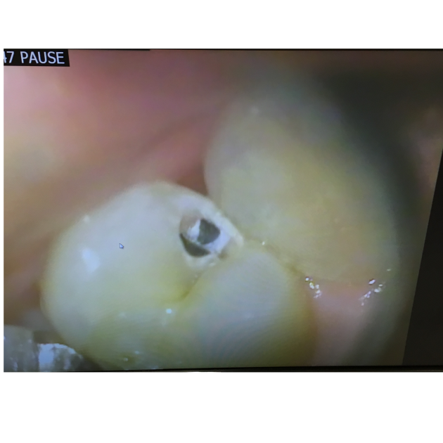 むし歯の拡大画像