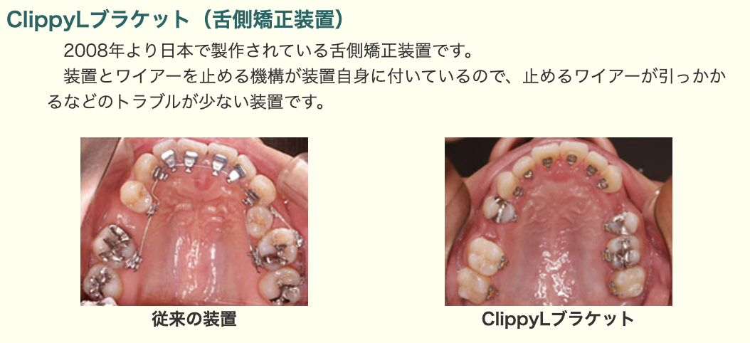歯の裏側に装置を装着することで目立たずに歯並びを整えられる方法です