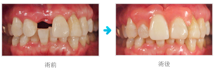 「ハリウッド義歯」をもちいた治療例