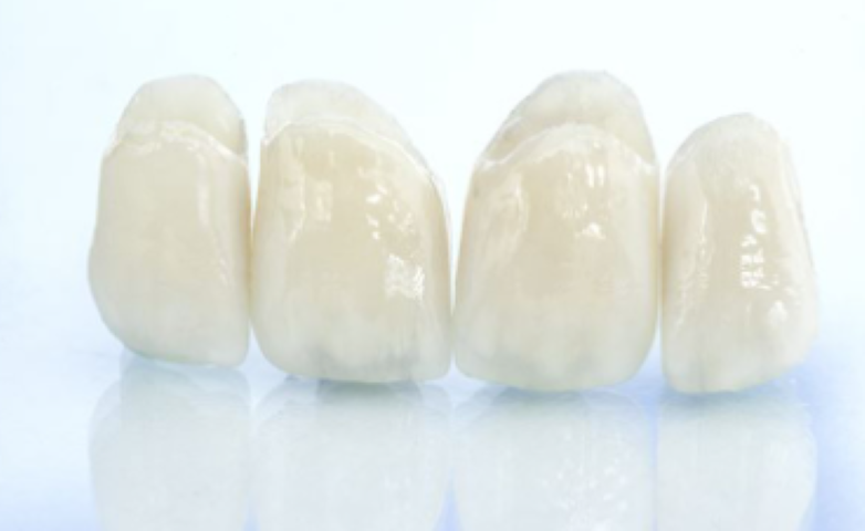 患者様に合ったつめ物・かぶせ物を提供