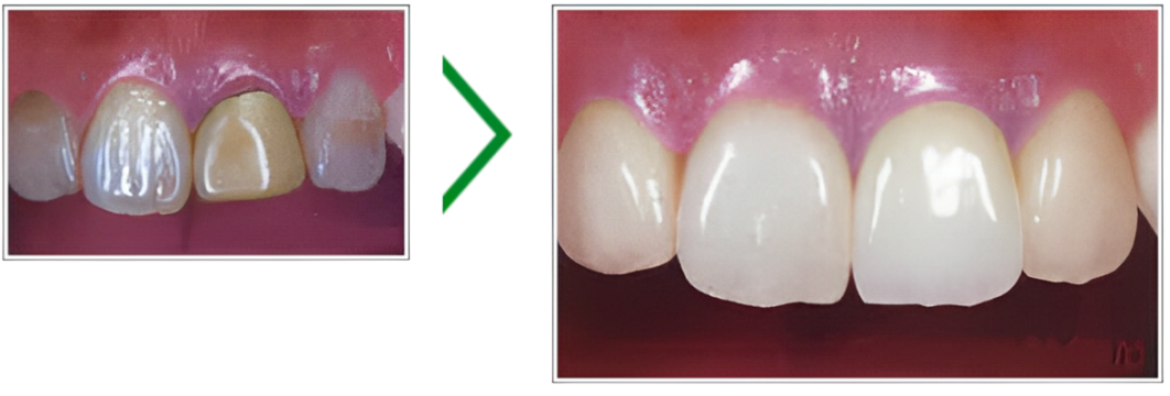 セラミックの中のセラミックともいえるジルコニア