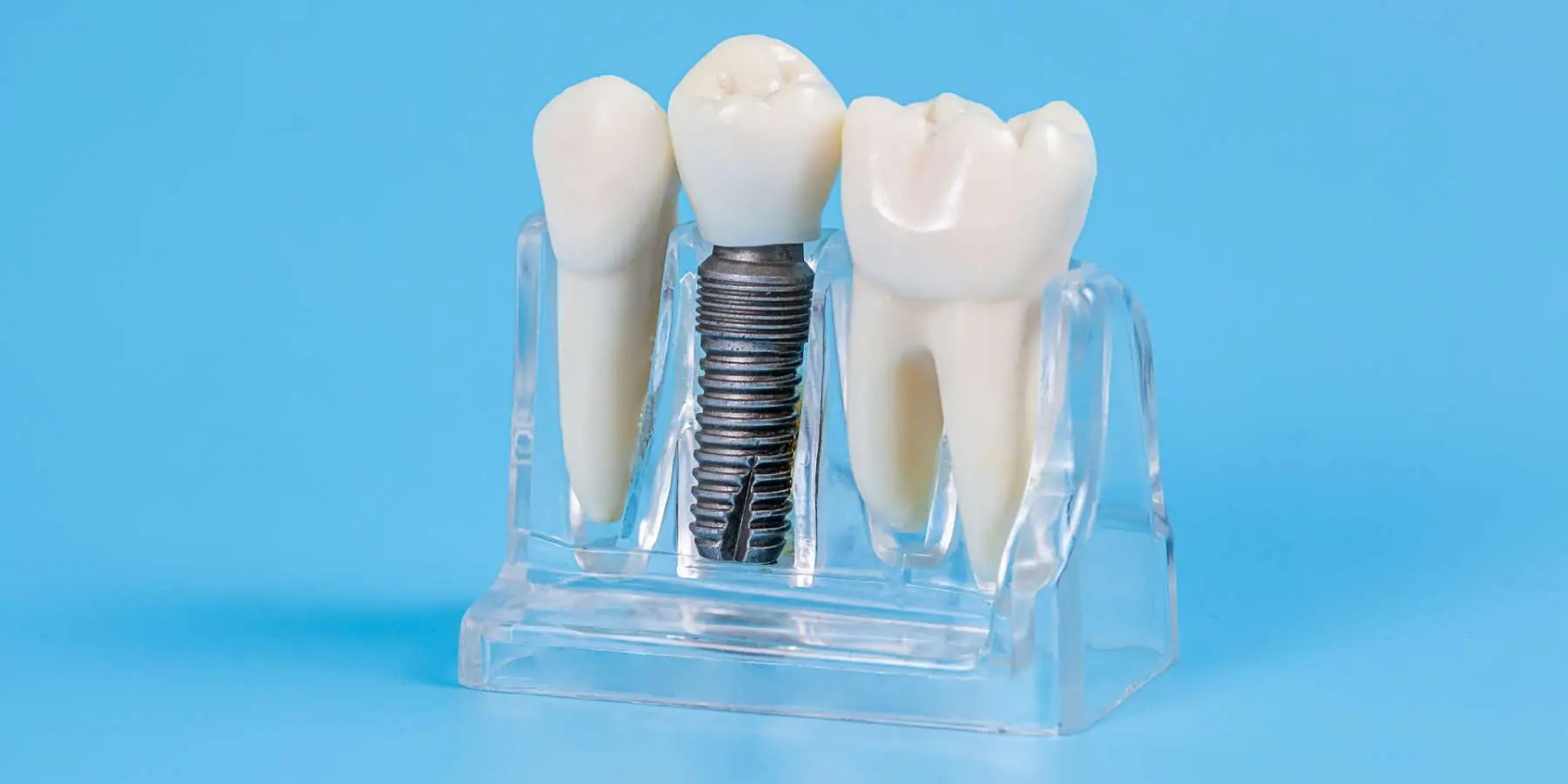 経験豊富な院長による信頼のインプラント