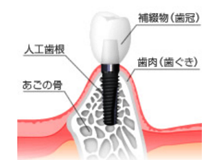 入れ歯よりもしっかりとした噛み心地で、取り外しの手間もありません
