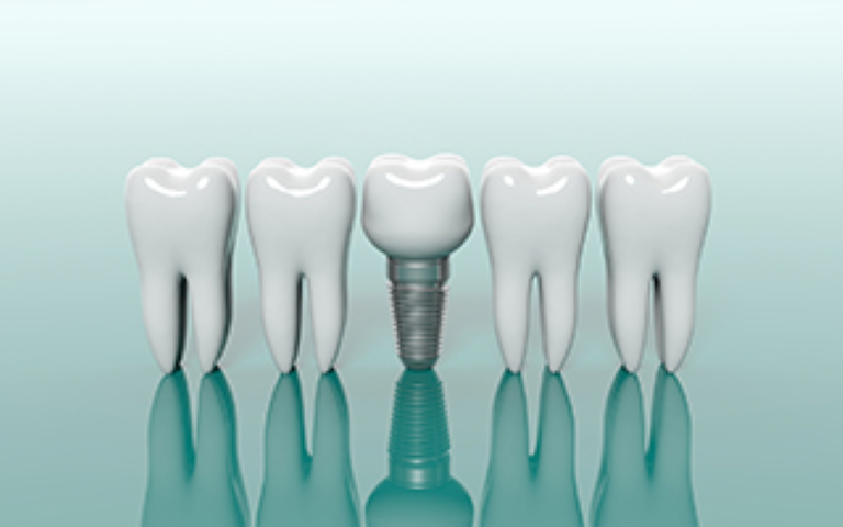 見た目と機能性に優れたストローマンインプラント