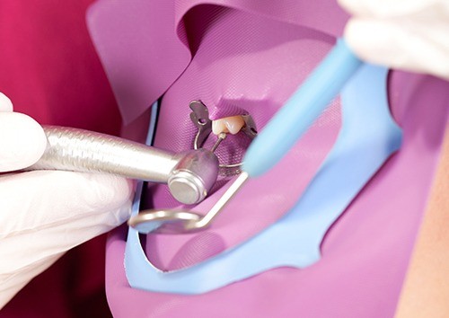 精密な根管治療を通じて、天然歯の長期保存を目指しています。