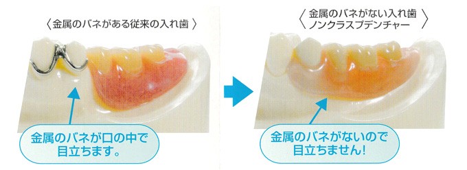 ノンクラスプデンチャー