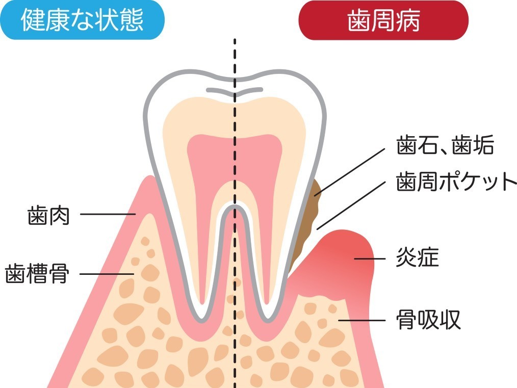 定期的な歯科検診で歯肉の変化を早期に発見することが重要です