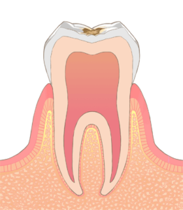 歯を大切に、削らず治す最新のケア