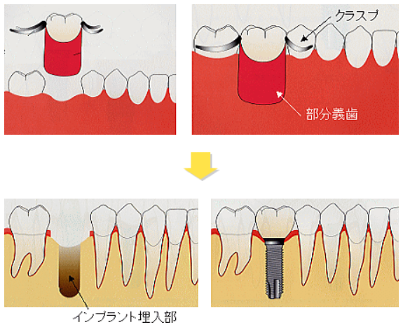 部分入れ歯が嫌な方のための治療例