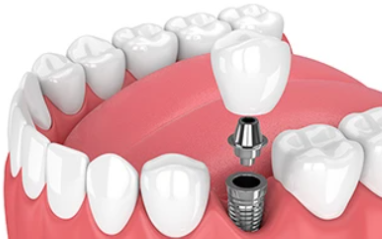 高度な技術と充実のサポートで提供するインプラント治療