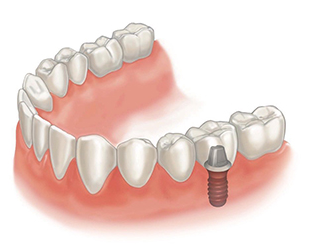 いしかわ歯科石神井公園クリニックが取り入れている「ストローマンインプラント」は、長期的な治療成績においても高い評価を受けています。