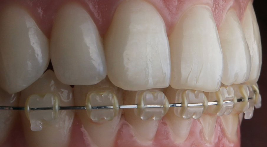 ハーフリンガルブラケット矯正装置