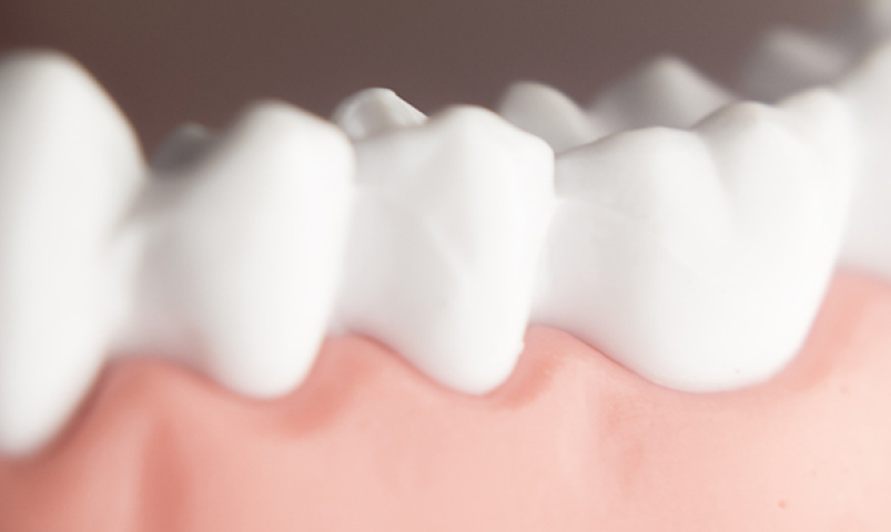 継続的なケアで歯周病対策を行います。