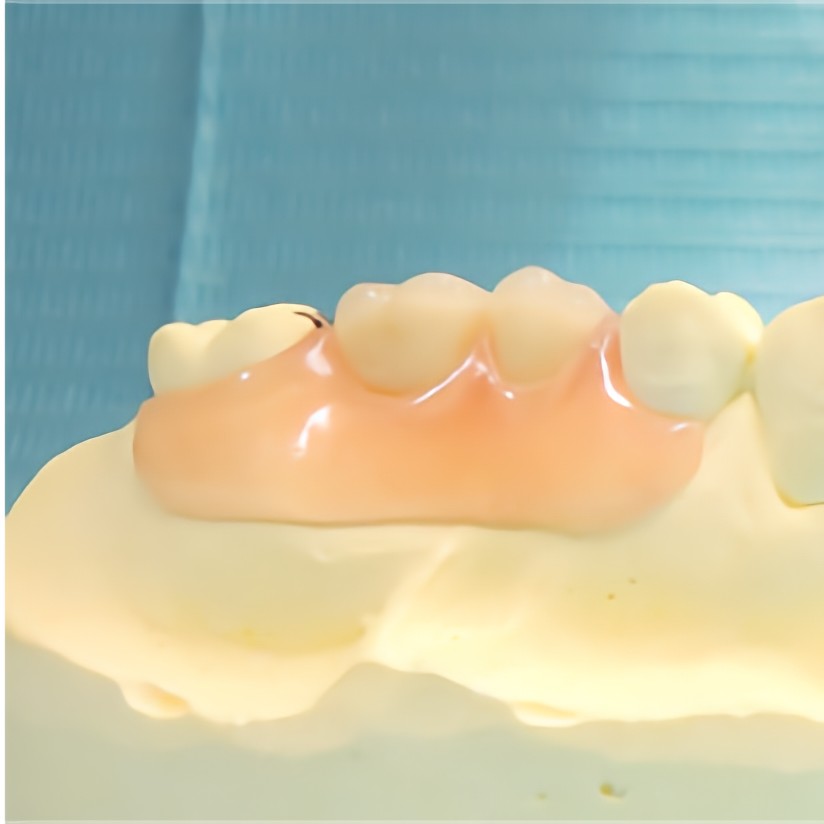 ノンクラスプデンチャー