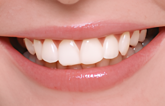 セラミックとホワイトニングで白く輝く健康的な笑顔を創出