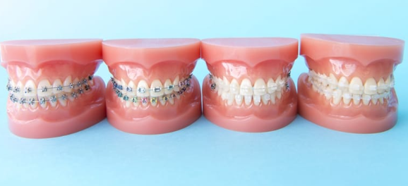 「白く目立ちにくい矯正装置」の例