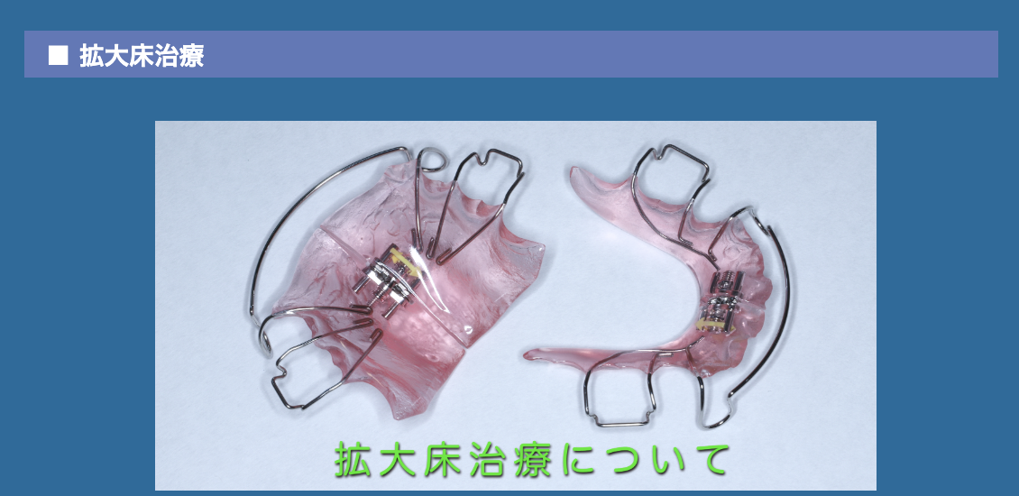 拡大床治療は、永久歯がきれいに並ぶためのスペースを作ることを目的とした方法です