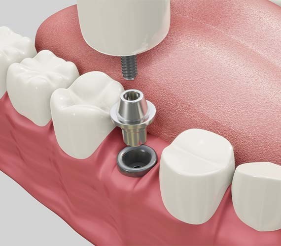 噛む力を取り戻したいと考える患者様にとって、長期的な視点で検討できる治療法です。