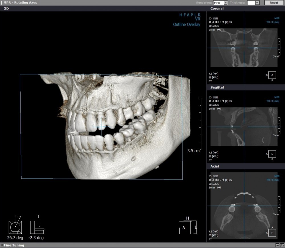安全性と正確性を重視したインプラント治療を行っています。