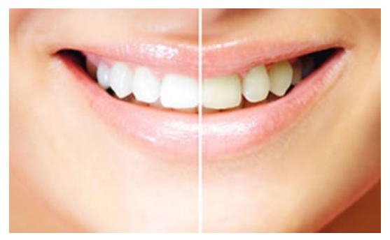 歯を守りながら美しく輝くホワイトニング