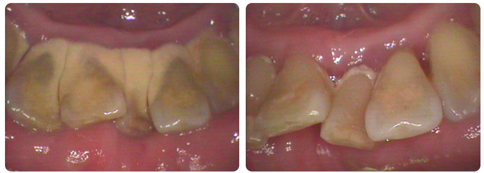 歯の裏側は特に歯石に気づきにくい部分です