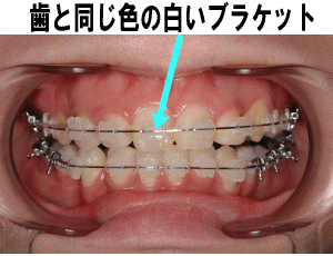 白いブラケットをご用意しています
