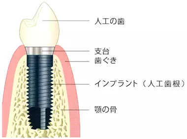 自分の歯のように噛める安心感