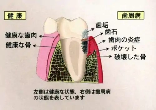 歯周病は歯の支えを破壊する病気です