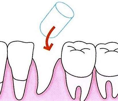 抜歯したスペースにテルプラグを充填