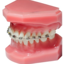 ワイヤー矯正で歯並びを整えます