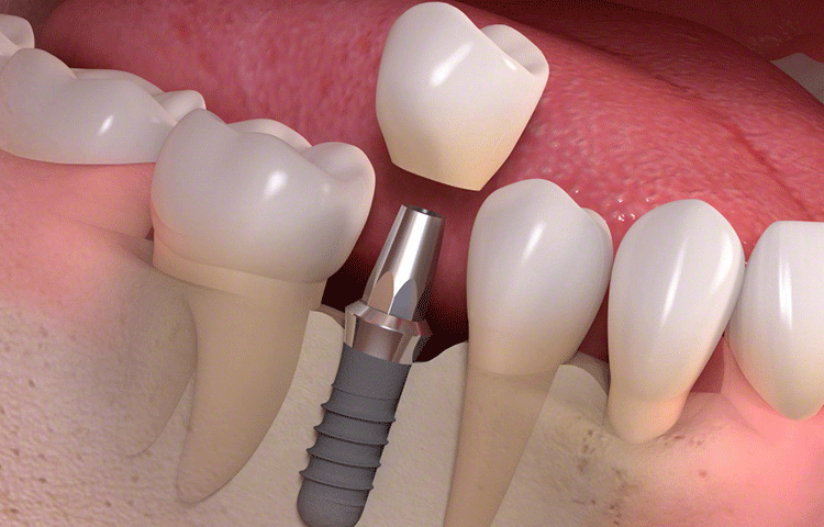 人工歯根を埋め込む手術を行うため、まずは無料相談をオススメします