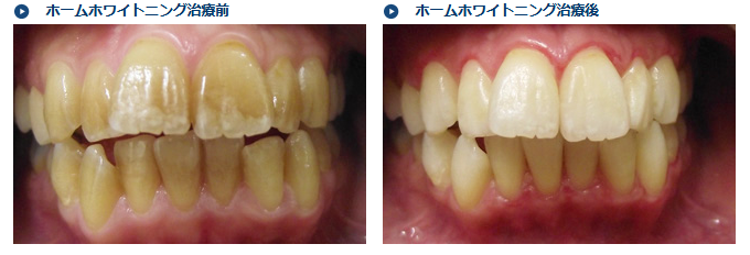 ホームホワイトニングでここまでキレイになります