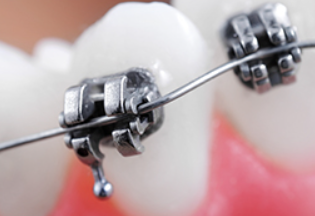 歯並びのお悩みをお聞かせください