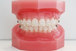 歯並びの状態や希望に合わせて装置を選択できる環境を提供しています。