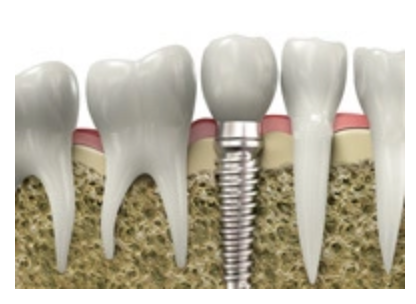 インプラントは天然歯と同じ感覚で噛むことができます