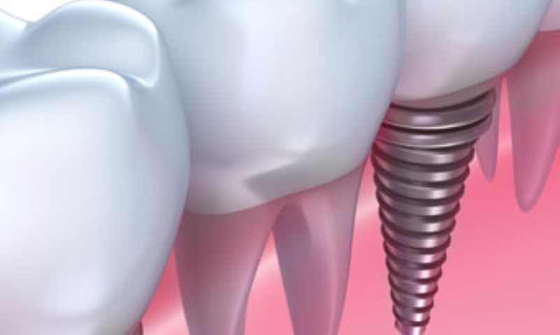 機能性と美しさを両立するクローバー歯科のインプラント