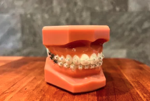 「矯正中も笑顔を大切にしたい」という方に、アポロデンタルクリニック西新宿の目立ちにくい矯正治療は最適です