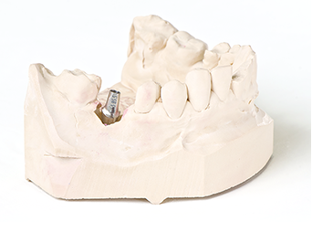 本当の歯のような機能性と審美性を兼ね備えたインプラント