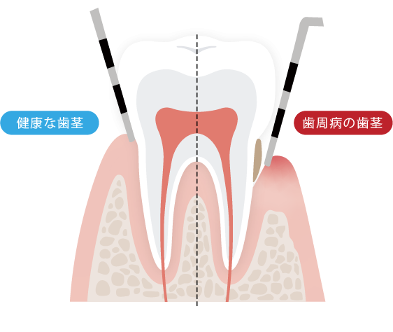 プローフという器具により歯周ポケットを検査します