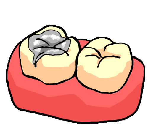 詰め物　インレー