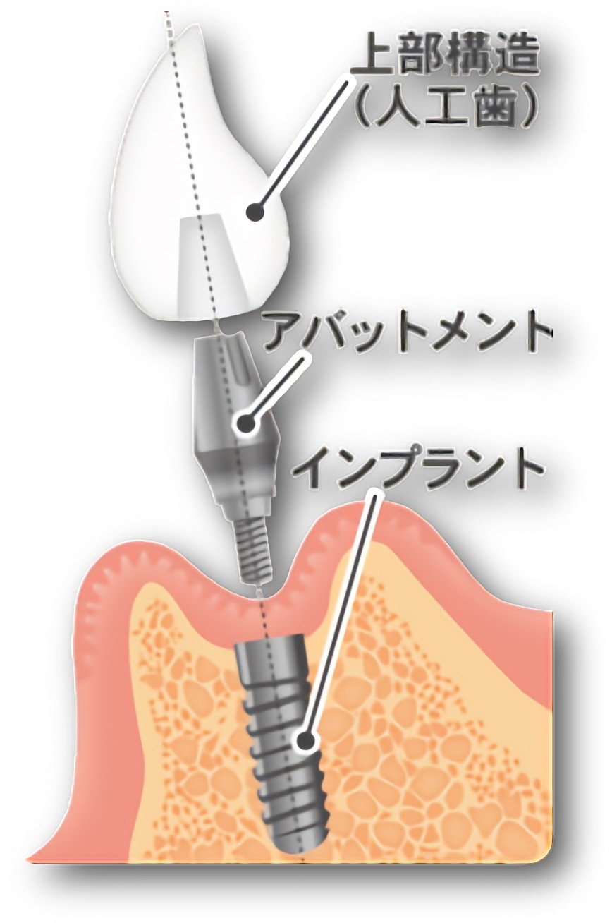 品質の高いインプラントを使用しています