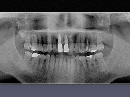 失われた歯牙を人工の歯根（チタン合金製）によって再建する方法です