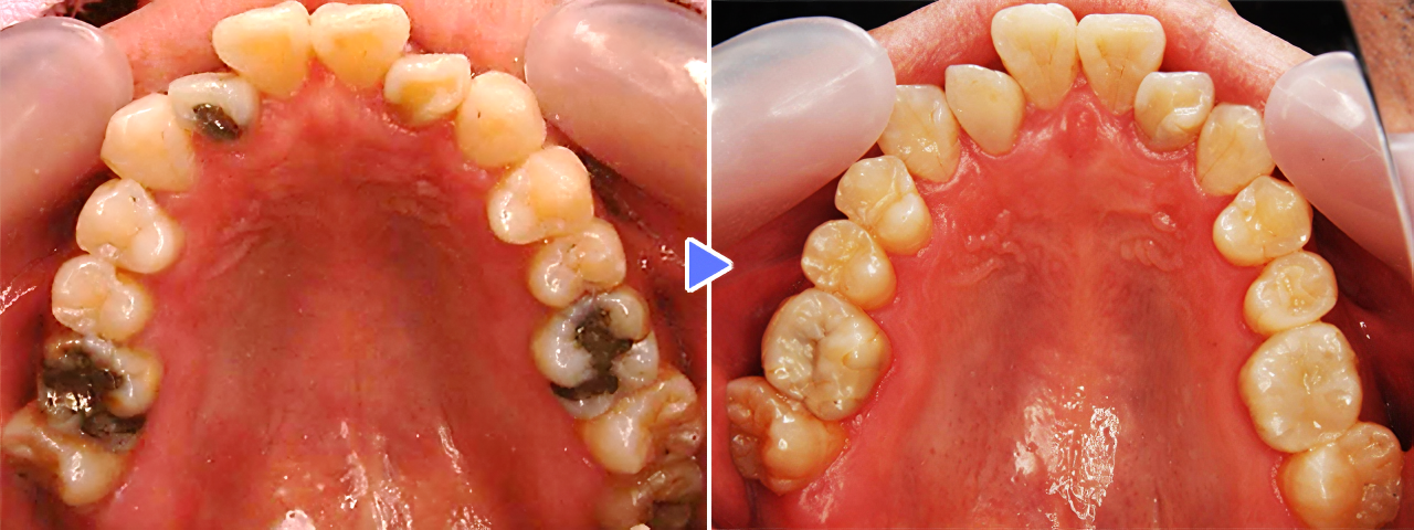 歯をなるべく綺麗に、そして長く残すことを大切にしています
