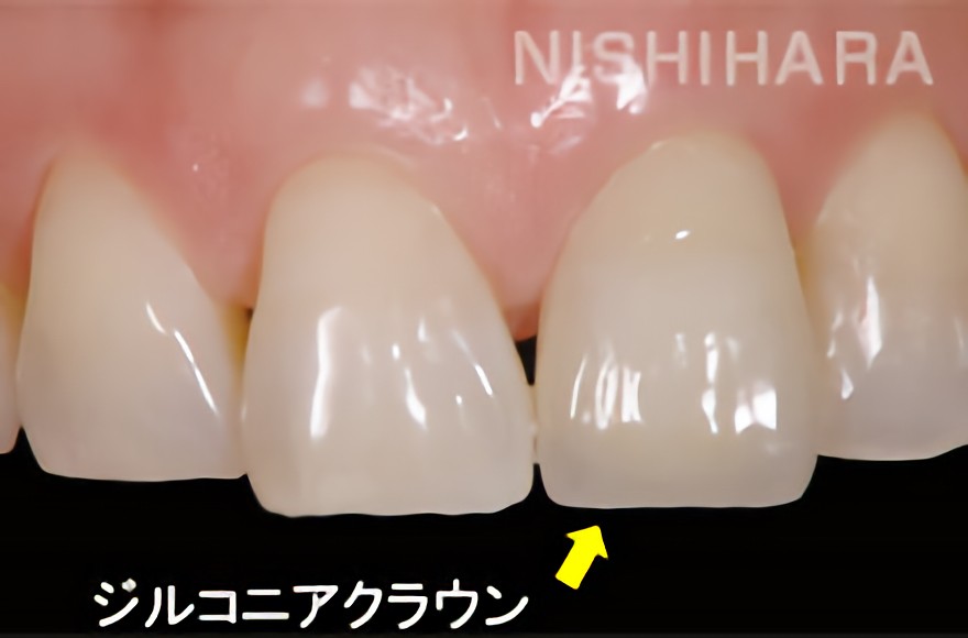 ジルコニアクラウン