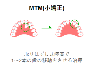 おもに前歯の矯正を行います
